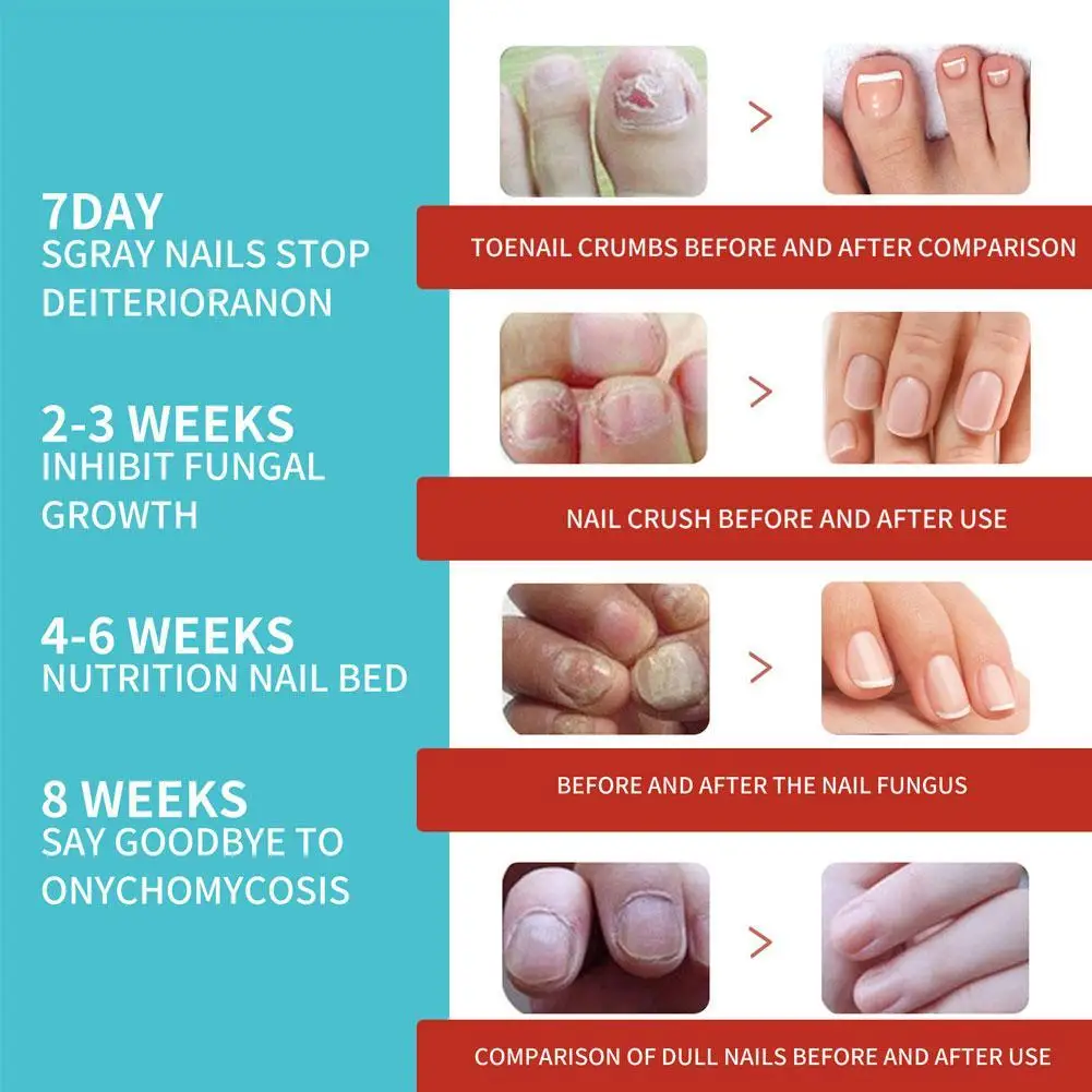 South Moon Nail Treatment Patch Anti Fungal Nail Correction Repair Care Anti Infection Stickers Ingrown Tool Paronychia Toe T9S3