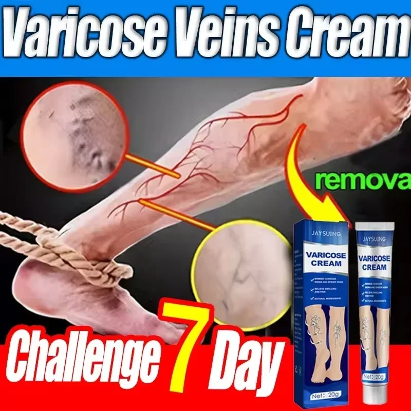 Ointment for Varicose Veins Eliminate Vasculitis Phlebitis to Relieve Spider Leg Pain Treatment Herbal cream 4