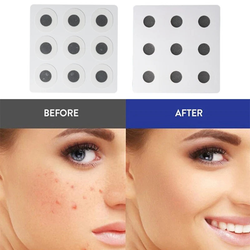 Water Soluble Salicylic Acid Stickers Microneedles Skin Treatment Face Acne Soothing Blemish Pimple Removal Patches 9 Pcs