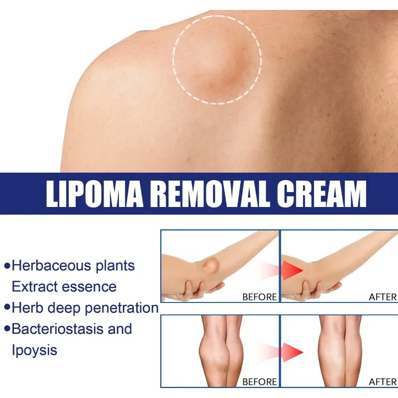 Lipoma Removal Ointment Cellulite Treatment Fibroma Remover Subcutaneous Lumps Multiple Lipomas Fat Mass Medicines Cream 20G cream lumps remover