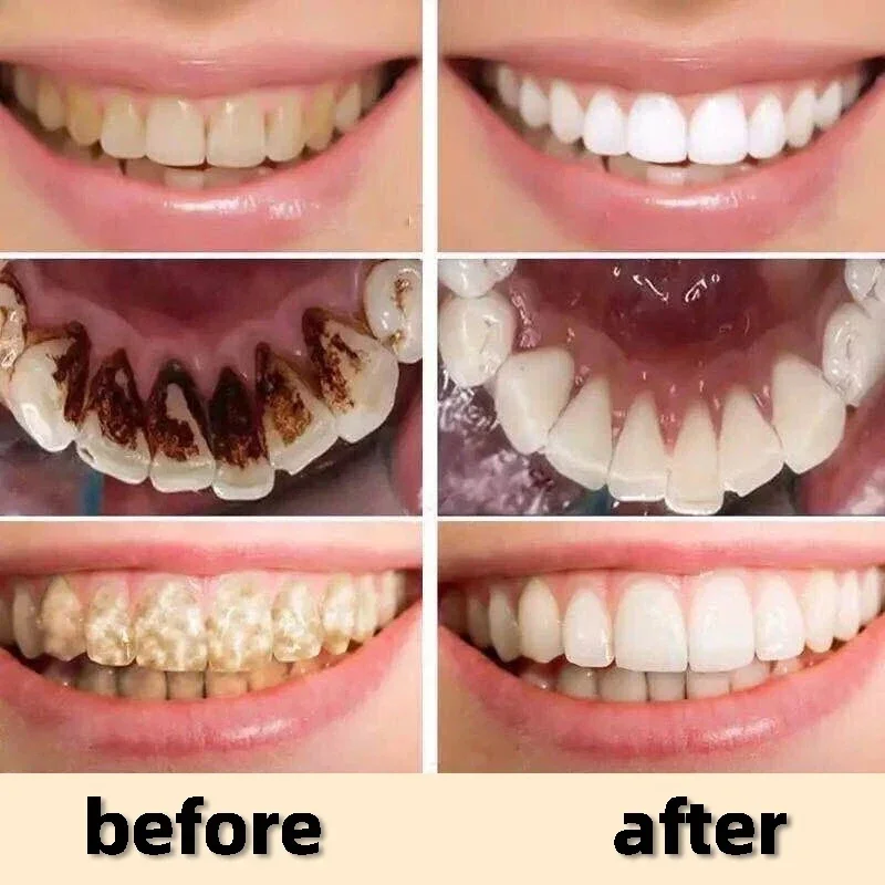 Dental Calculus Remover Whitening Teeth Mouth Odor Removal Bad Breath Preventing Periodontitis Oral Health Care