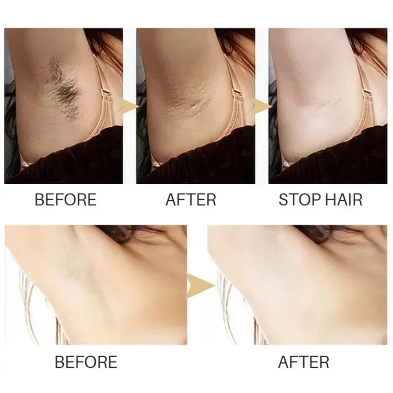 Hair Removal Spray Powerful Epilator Cream Intimate Areas Health Painless Hair Remover Growth Inhibitor For Woman Men Body Care hair removal spray