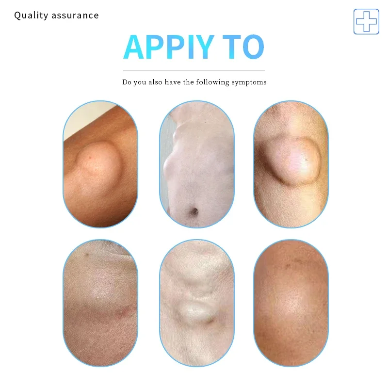 Lipoma Removal Soothing Cream Relief Pain Fibroma Subcutaneous Fat Lumps Remover Spray Cellulite Treatment