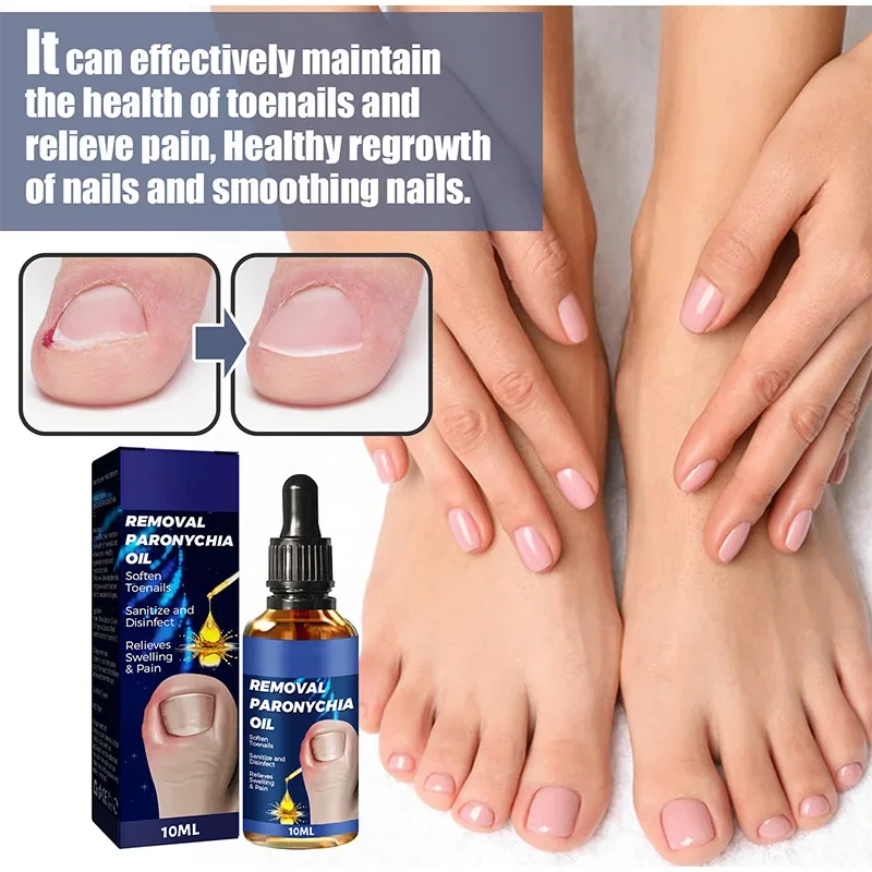 Toenailcare Removal Paronychia Oil Ingrown Toenail Treatment U&ntilde;as Renewal Liquid Bad Nail Thicken Nail Soft Repair Solution manicure pedicure tools nail fungus remover