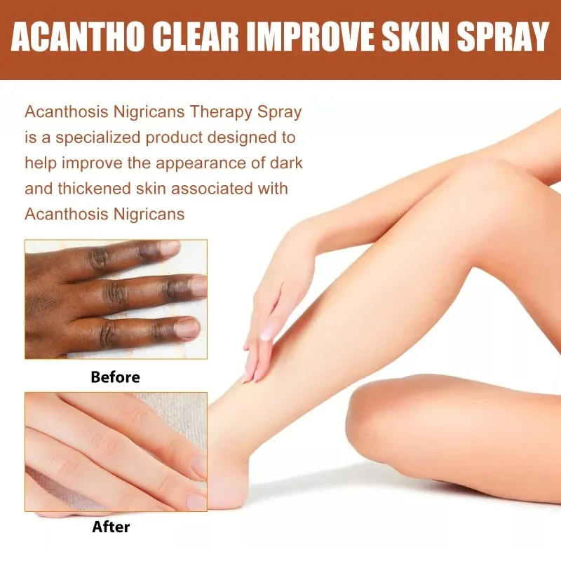 

Sdotter Acantho clear spray Armpit Elbow Knee joint Dark Knuckle Removal Whitening Serum Thigh Inner improve Melanin Dull body s