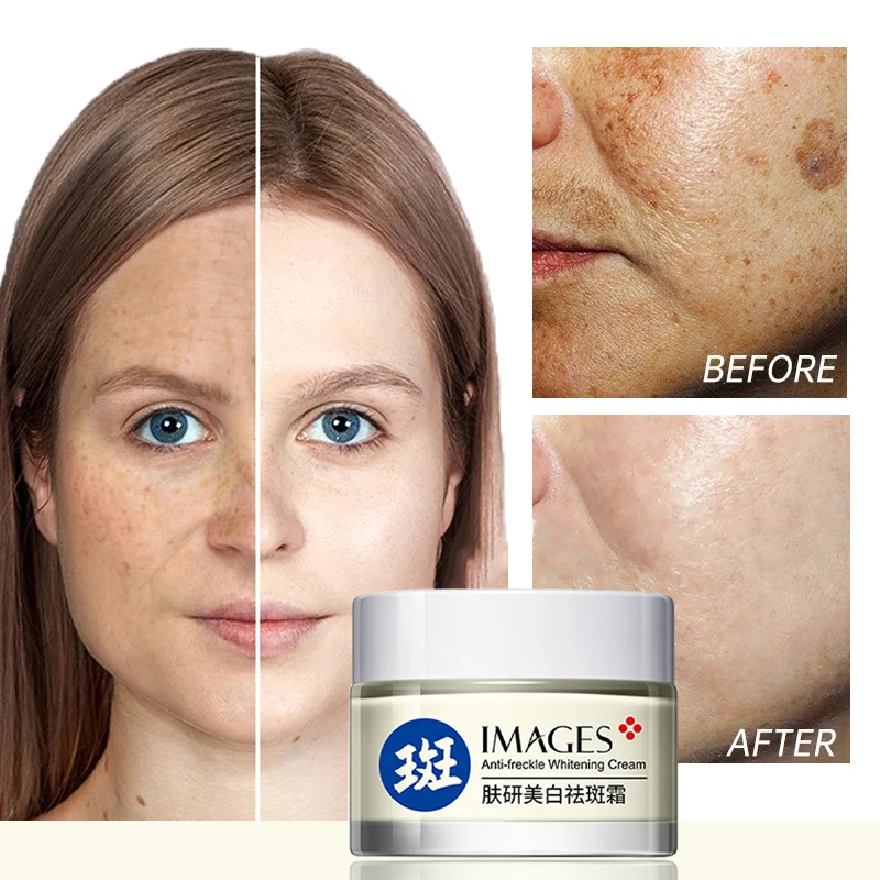 

Whitening Freckle Removing Cream Effectively Removes Chloasma Age Spots Sunburn Lightening Pigments Moisturizing Skin Care 50g