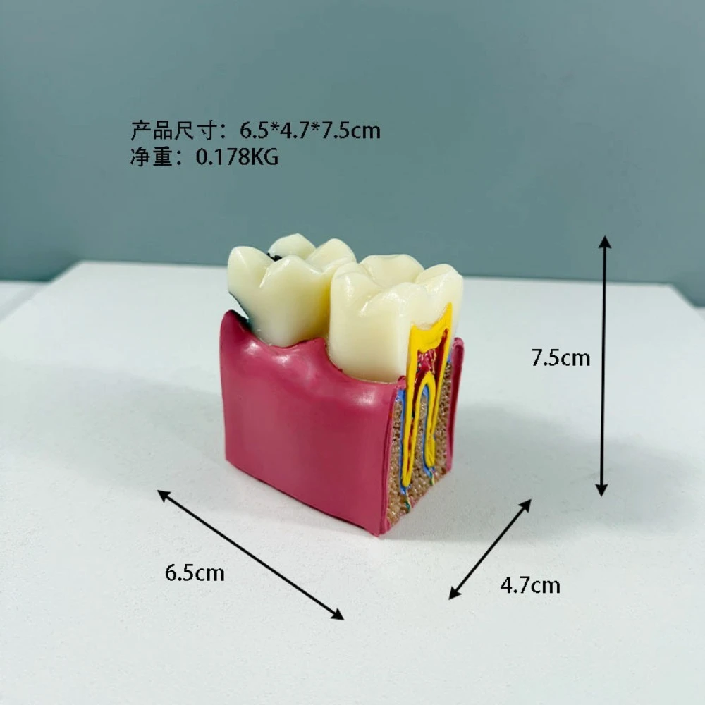 치아 모형, 치아 부패 절개 시연, 치아 금형6부패된 치아 비교