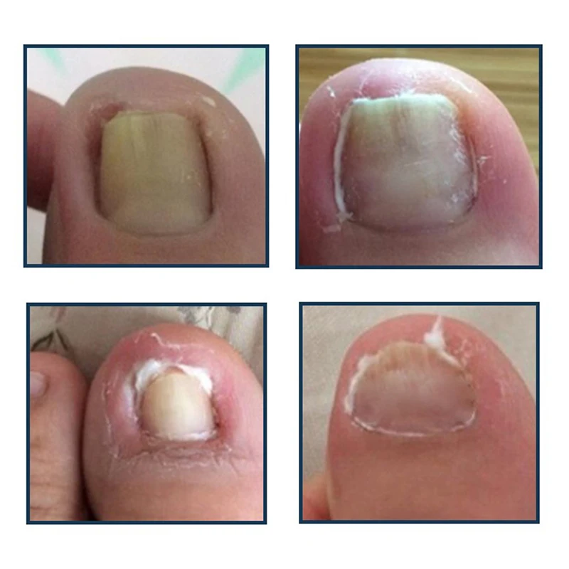 Nail Art strumento per la correzione delle unghie dei piedi incarniti ortesi per unghie dei piedi Clip per paronichia - immagine 5