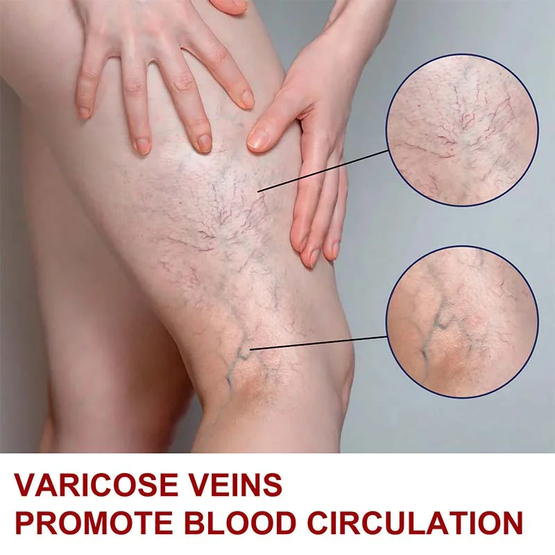 Varicose Veins Treatment Cream Relieve Legs Tired Dilated Vasculitis Phlebitis Spider Pain Relief Ointment Medical Body Plaster