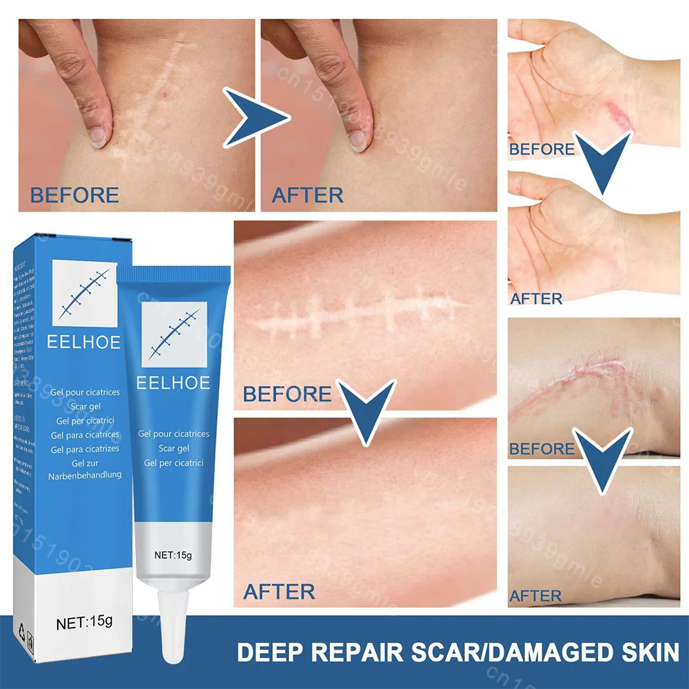 Scar Repair Gel Pen Treatment Improve Keloid Stretch Mark Whitening Body Care