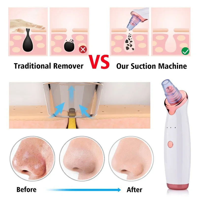 Vacuum Blackhead Remover Face Black Spots Cleaner White Dot Pimple Removal Tools Pore Acne Pimple Removal Facial Beauty Clean