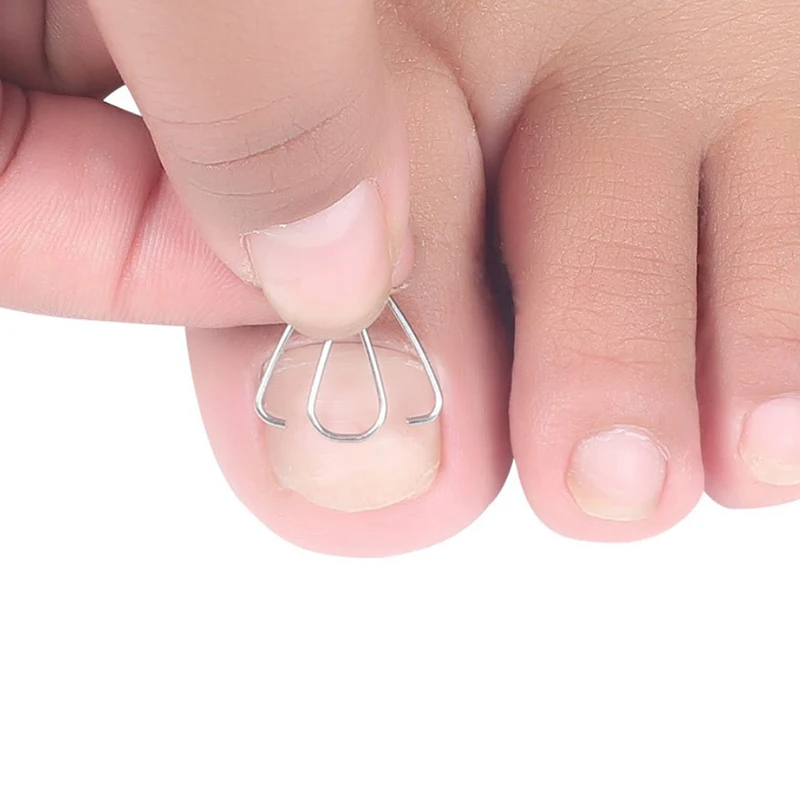 Nail Art strumento per la correzione delle unghie dei piedi incarniti ortesi per unghie dei piedi Clip per paronichia - immagine 2
