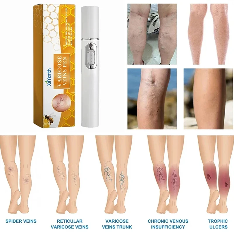Laser Treatment Varicose Vein Ointment Lampshade Therapy Varicose Veins Legs Relief Dilated Vasculitis Phlebitis Blood Circulation