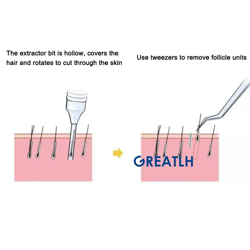 Hair Follicle Extractor Hair Transplant Implanter 0.8 MM 0.9MM 1.0MM