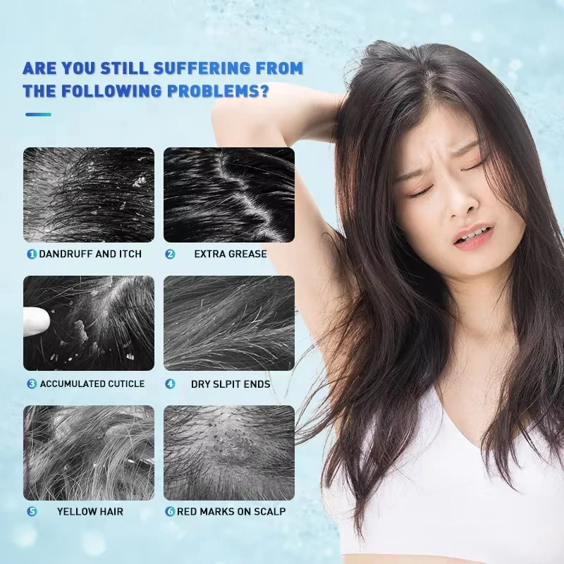 Hair Scalp Treatment Essence Anti Dandruff Itching Oil Control Anti Loss Scalp Cleaning Repair Serum Beauty Hair Care Products