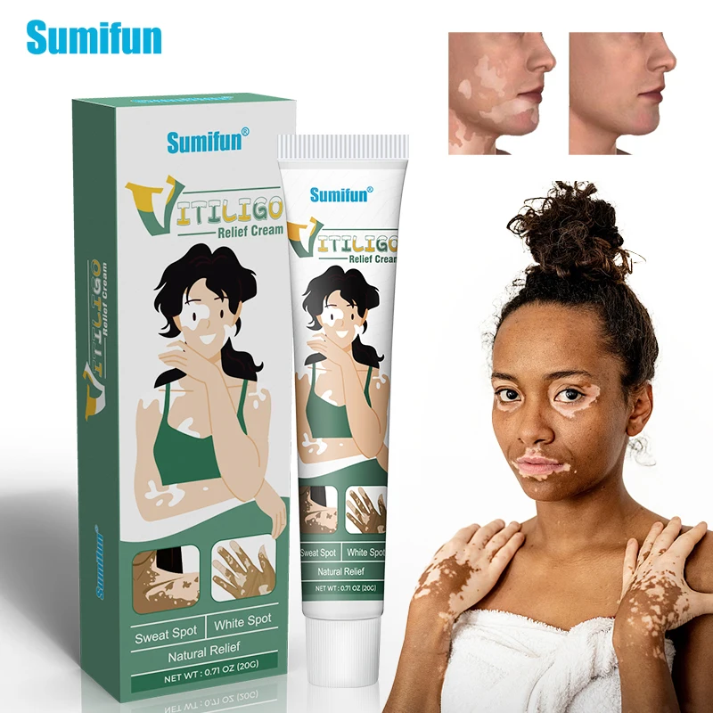 

20g Sumifun Vitiligo Treatment Cream White Spot Antibacterial Ointment Localized Leukoplakia Repair Medical Herbs Beauty Health