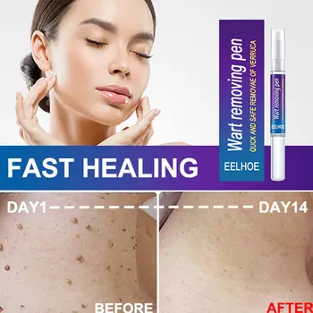 Wart Removal Mole Remedy Liquid Pen Treatment Papillomas Removing Skin Labels Flat Wart Genitals Painless Beauty Herbal Cream 3