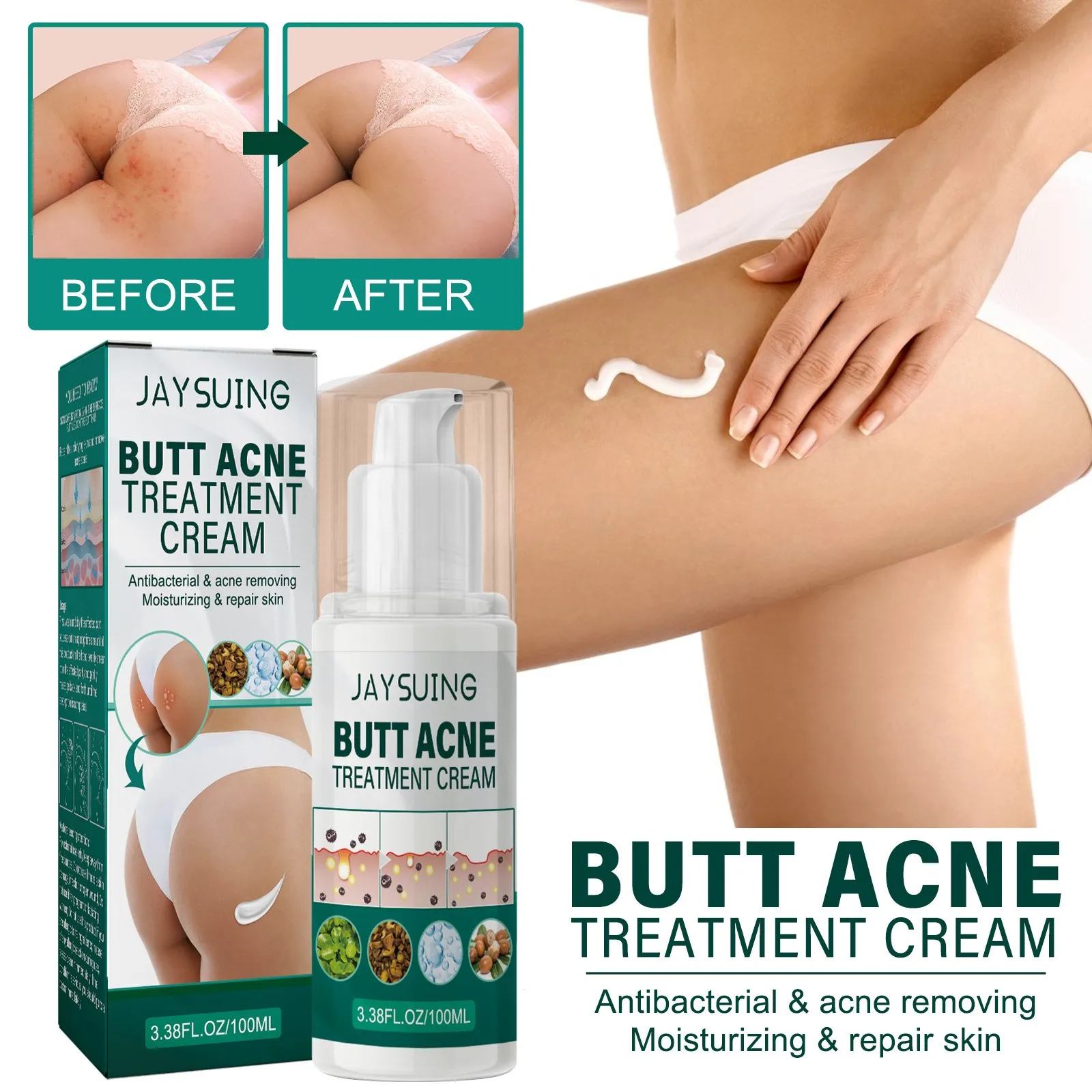 Butt acne Treatment cream gentle repair nourish Hip dilute Pimple Scar Removal body Acne Spot Moisturizing tender skin care
