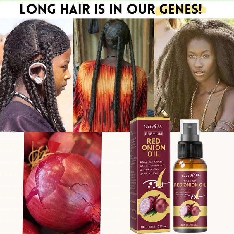 Onion Oil For Extreme Hair Growth, Breakage, Scalp Treatment, Alopecia Anti Hair  Loss Fast Grow Prevent Hair Dry Oil - Hair Loss Product Series - AliExpress