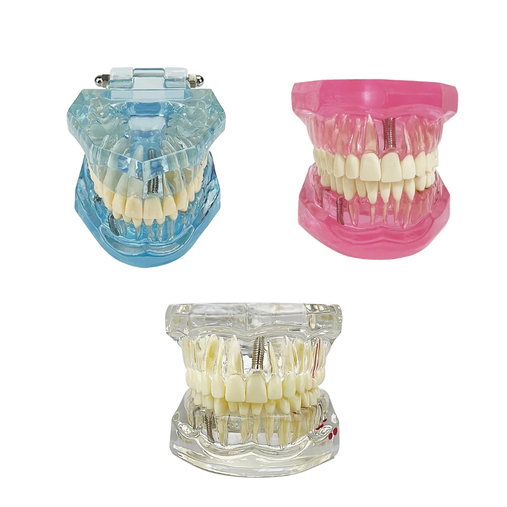 Modelo De Ortodoncia Dental Tipodonte/modelo De Restauración Dental De Modelo De Restauración De Prótesis 303948498626