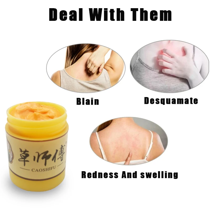 10g ZB Psoriasis cream treating eczema dermatitis antibacterial ointment urticaria natural plant skin itching repair pain relief cream