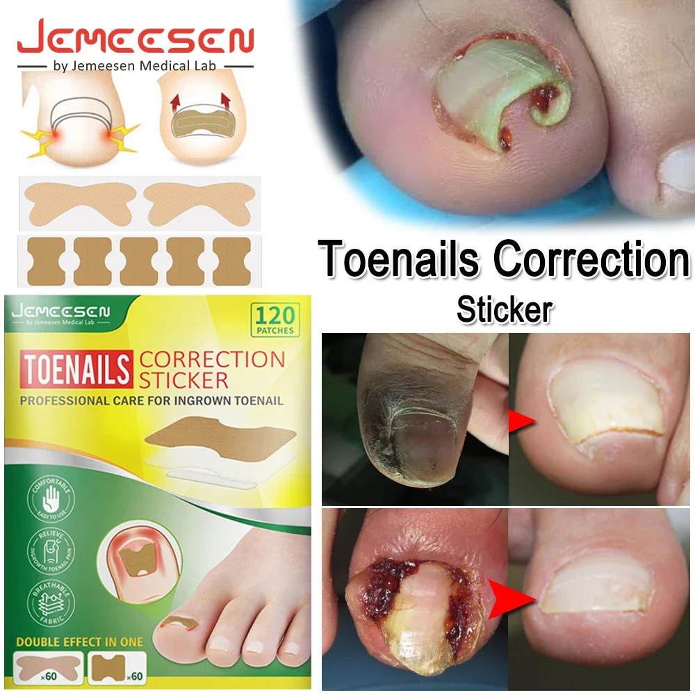 

Jemeesen Toenail Corrector Patches Ingrown Toenail Correction Stickers Relieve Nail Groove Paronychia Treatment Patch Foot Care
