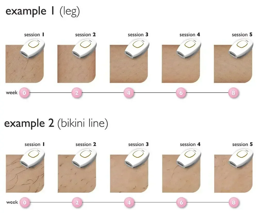 Ipl Laser Haarentfernungsgerät Für Gesicht Und Körper Epilierer_voghion.com