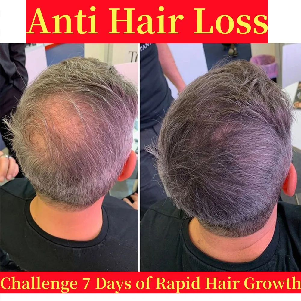 7DaysGingerHairGrowthProductsEssentialOilNaturalFormulaAnti