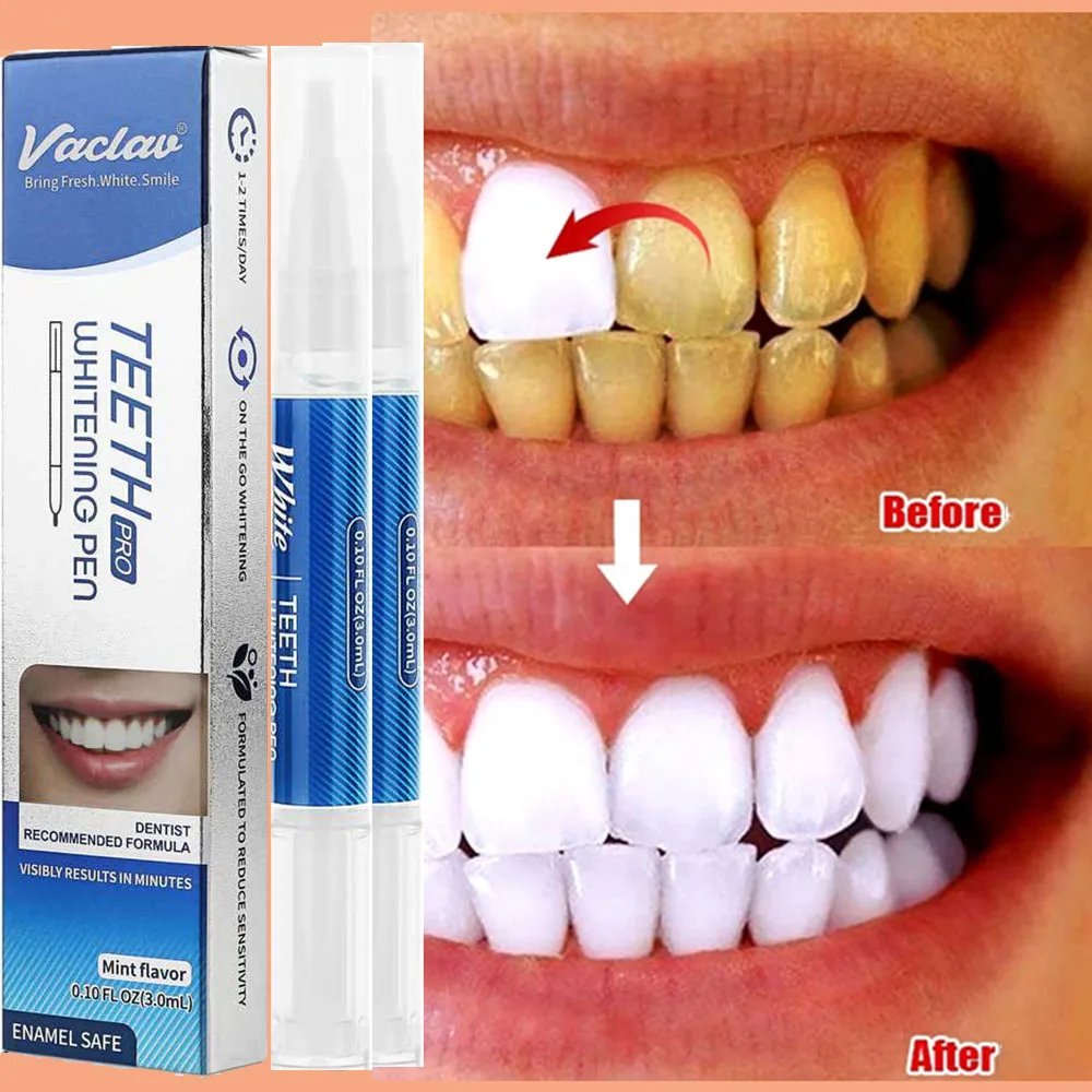 

Dentistry Teeth Whitening Pen Tooth gel Dental Products Tooth Gel Whitener Bleach Remove Stains Instant Smile Kit Essence Beauty