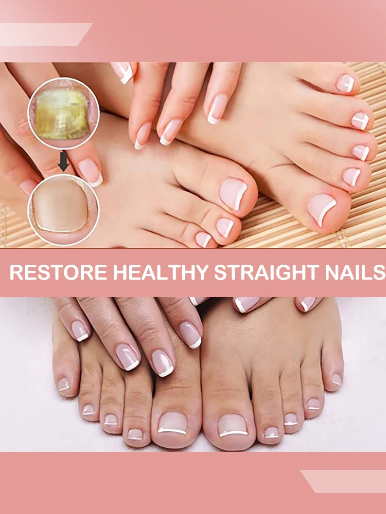 

Fungus Treatment Serum Toe Foot Fungal Repair Products Hand Care Removal Gel Anti Infection Onychomycosis Paronychia
