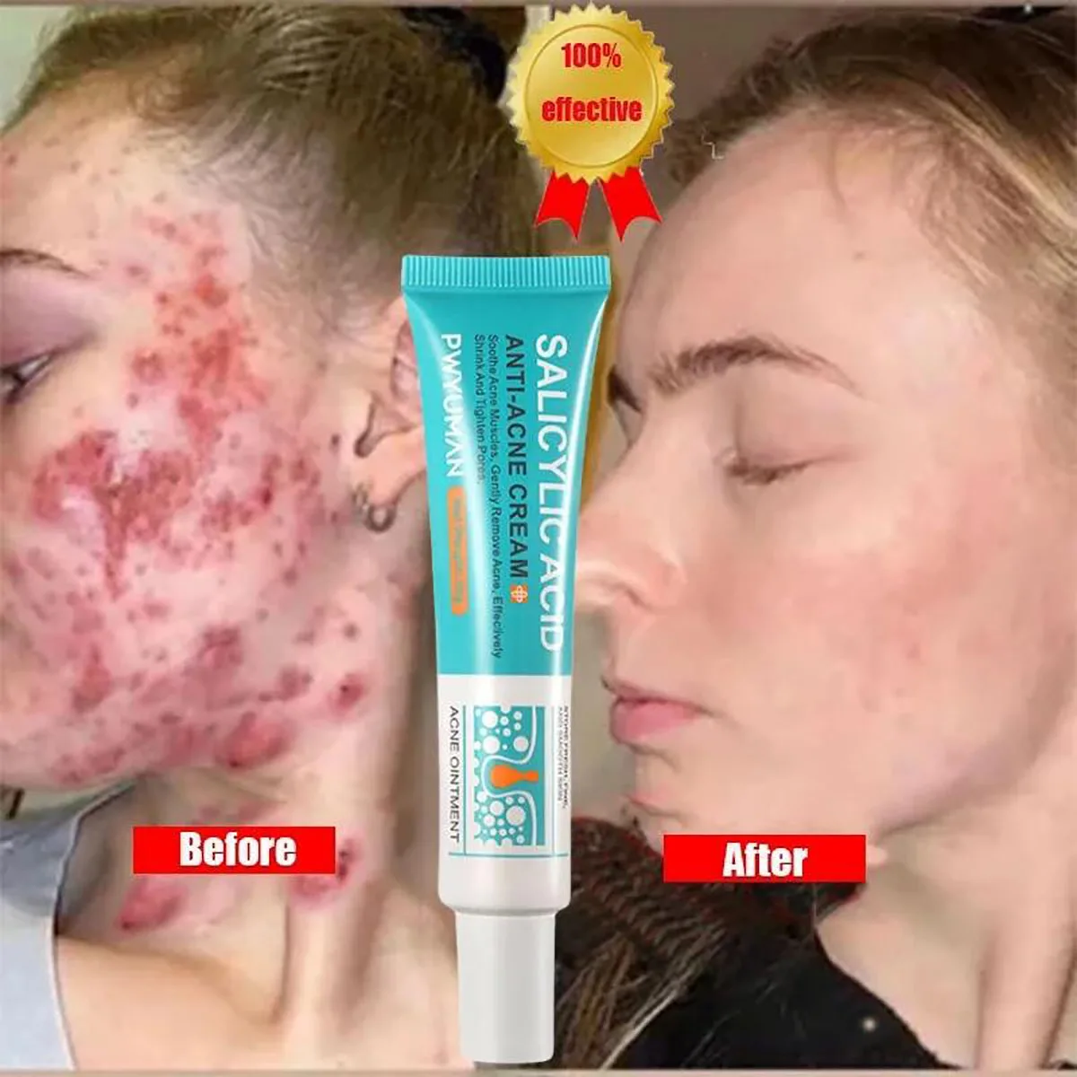 

Salicylic Acid Acne Treatment Face Cream Anti Pimples Spots Acne Removal Gel Repairing Scars Pores Shrink Oil Control Skin Care