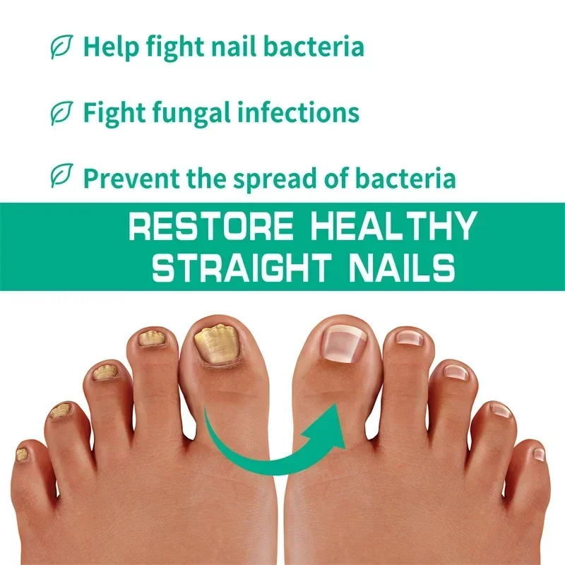 Beauty Health Nail Fungus Treatment Anti-Infection Nail Fungal Removal Essence Nails Fungus Treatments Serum Spray Repair Toe