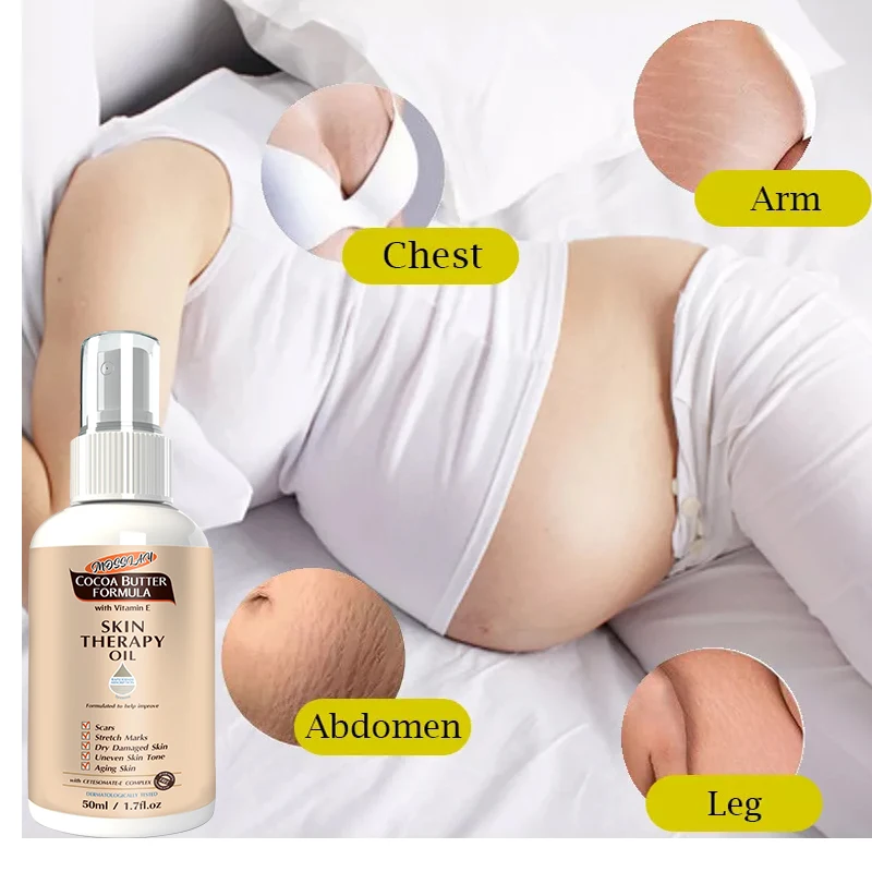 Stretch Mark Spray  Repair  Removal Acne Scar Stretch Marks Cream Fat Scar Striae Gravidarum Treatment Streaks Obesity