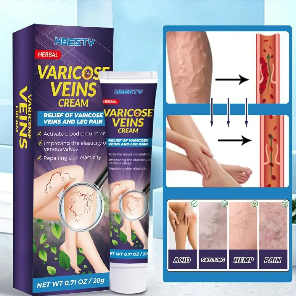 

varicose Veins Remove Legs Relief Pain Vasculitis Phlebitis Spider Foot Care Ointment Effective Treatment Varicose Veins Cream