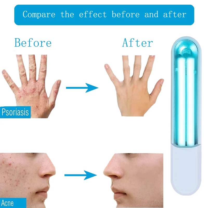 FODRK Home 311nm UVB Light Therapy Psoriasis  Vitiligo Treatment 311nm Psoriasis Laser UV Treatment