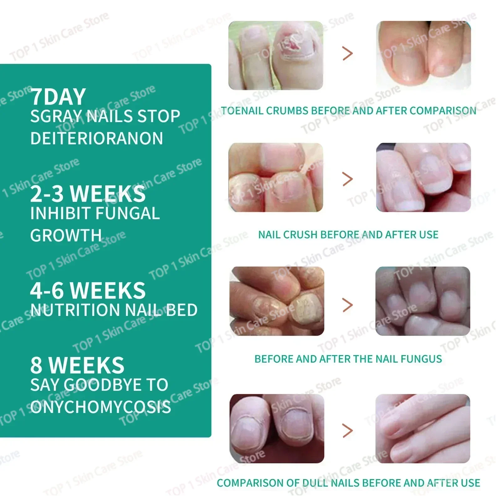 Fungal Nail Treatment Oil Foot Repair Essence Toe Nail Fungus Removal Gel Anti Infection Cream Fungal Removal
