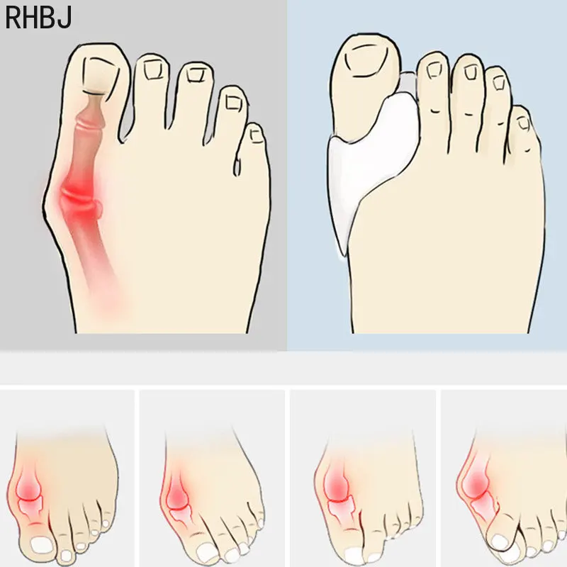 RHBJ 2Pcs Silicone Toe Separators Bunion Bone Ectropion Adjuster Toes Outer Appliance Hallux Valgus Corrector Foot Care Tools
