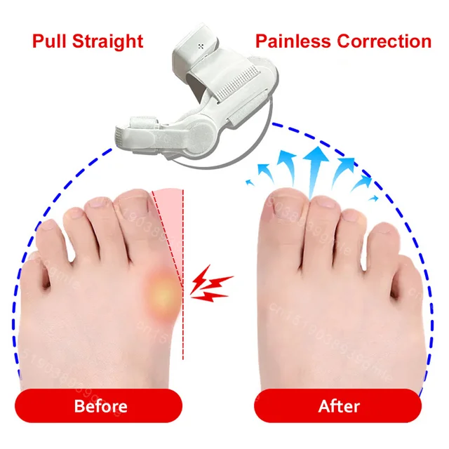 Electri Toe Separator Bunion Splint Straightener Corrector Hallux Valgus Protector Toe Orthotics Braces Bunion Toe Corrector 6