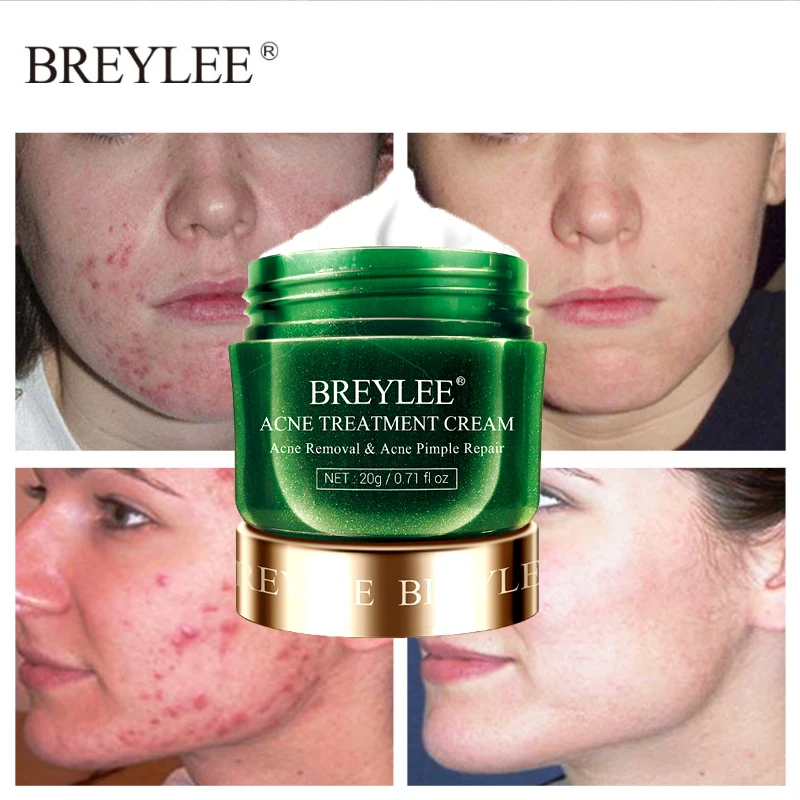 

BREYLEE Acne Treatment Cream Anti Acne Face Cream Pimple Removal Spots Oil Control Shrink Pores Moisturizing Skin Care Serum 20g