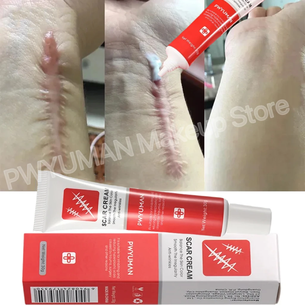 

Effective Scar Removal Cream Treatment Stretch Marks Burn Surgical Scar Ointment Acne Spot Repair Gel Whitening Smooth Skin Care