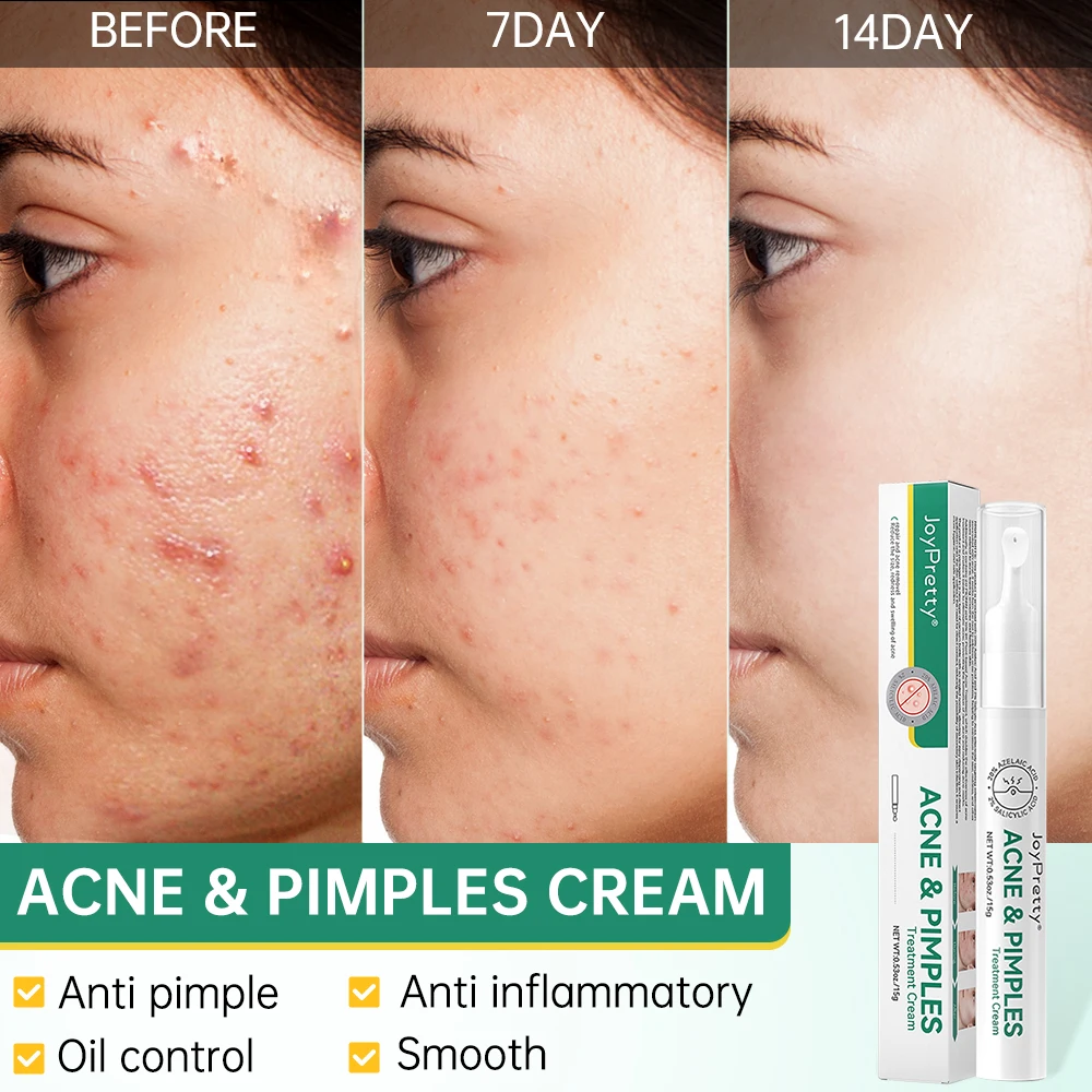 

Acne Face Cream Pimple Scars Removal Shrink Pore Oil Control Hyaluronic Acid Smoothing Acne Treatment Facial Creams Skin Care