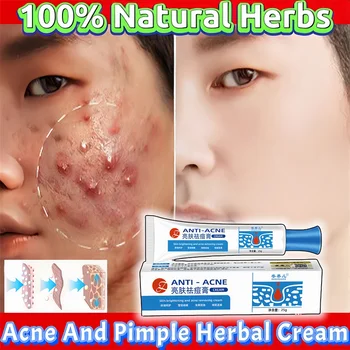 Crema per il viso per la rimozione dell'acne a base di erbe cancella la cicatrice dei brufoli punti neri gel trattamento dell'acne restringimento dei pori sbiancamento della pelle unguento schiarente