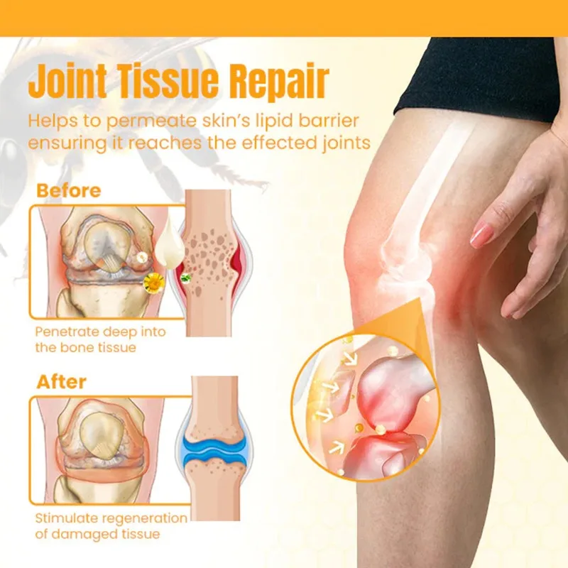 Bee Venom New Zealand Treatment Gel Cream Relieve Muscle Joint Pain for Legs Hands Arms Feet Health Care