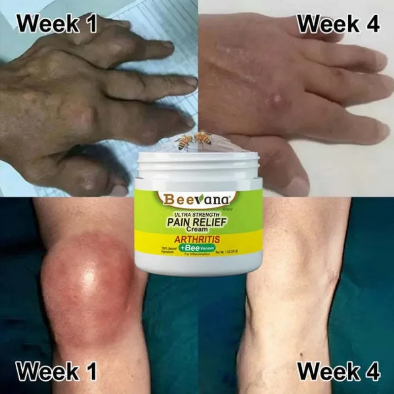 

Beevana Bee Venom Joint Collagen Cream Soothes And Relieves Joint Muscle Soreness And Promotes Bone Massage Joint Care Cream 30g
