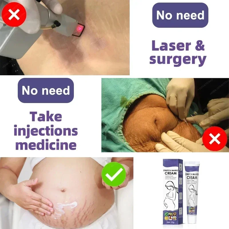 Swelling Marks Remove Skin Cracks Body Creams 6