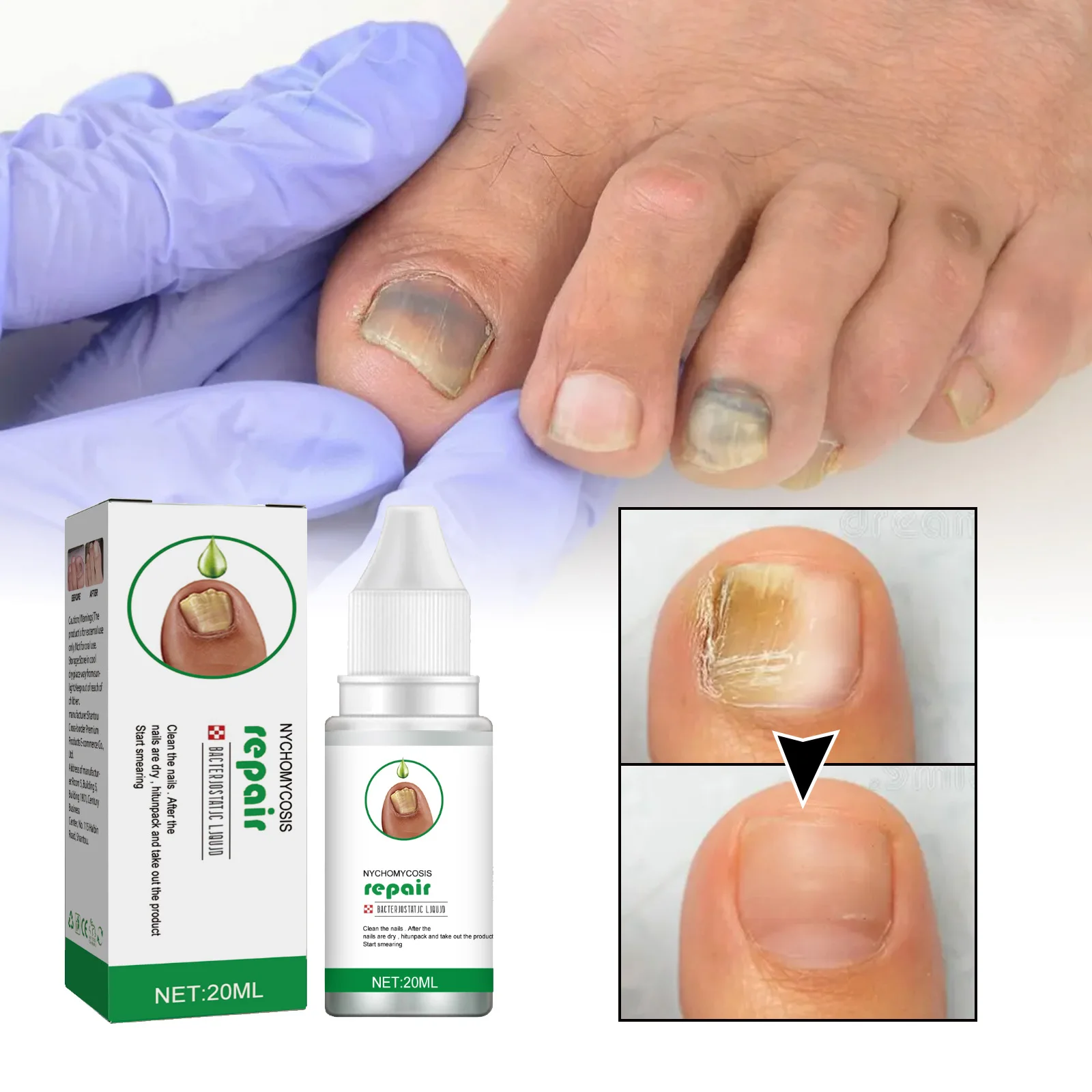 Nail fungus nail repair solution is used for discolored, thickened, and cracked nails S5F60