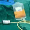 10-pcs Lot Pack Single Use 200ml Medical PVC Storage Bag for Autologou Fat/Autologous fat transfer 1