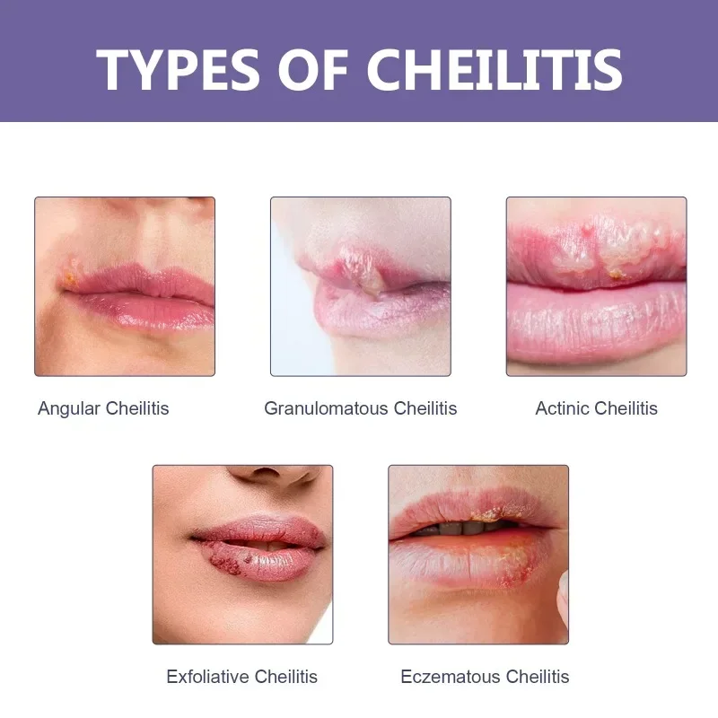 Cold Sores Patch Antibacterial Herpes Paste Repair Lip Skin Barrier Dry Cracked Moisturize Lips Care Treatment Cheilitis Sticker