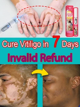 Nationally certified vitiligo white spot cure laser