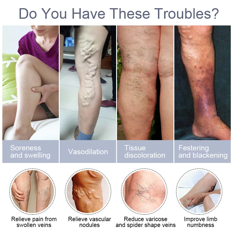 20g Varicose Vein Relief Cream Improves Blood Circulation Relaxing Leg Cream Relieve Spider Blood Vessels Anti Varicose pain analgesic cream varicose veins patch